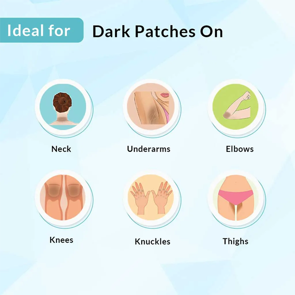 DermaPflege™ Acanthosis Nigricans Hyperpigmentierung Therapie Creme