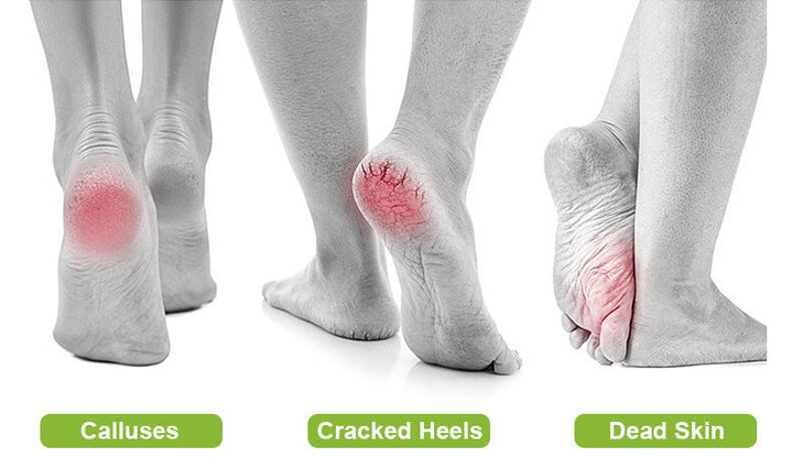 SoftFeet™ Elektrische Fußfeile