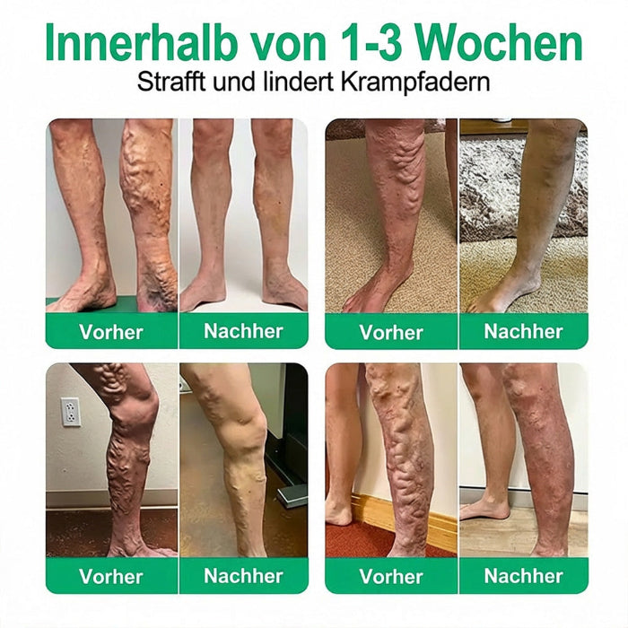 VenenSanft™ Mikronadel-Pflege für die Beine