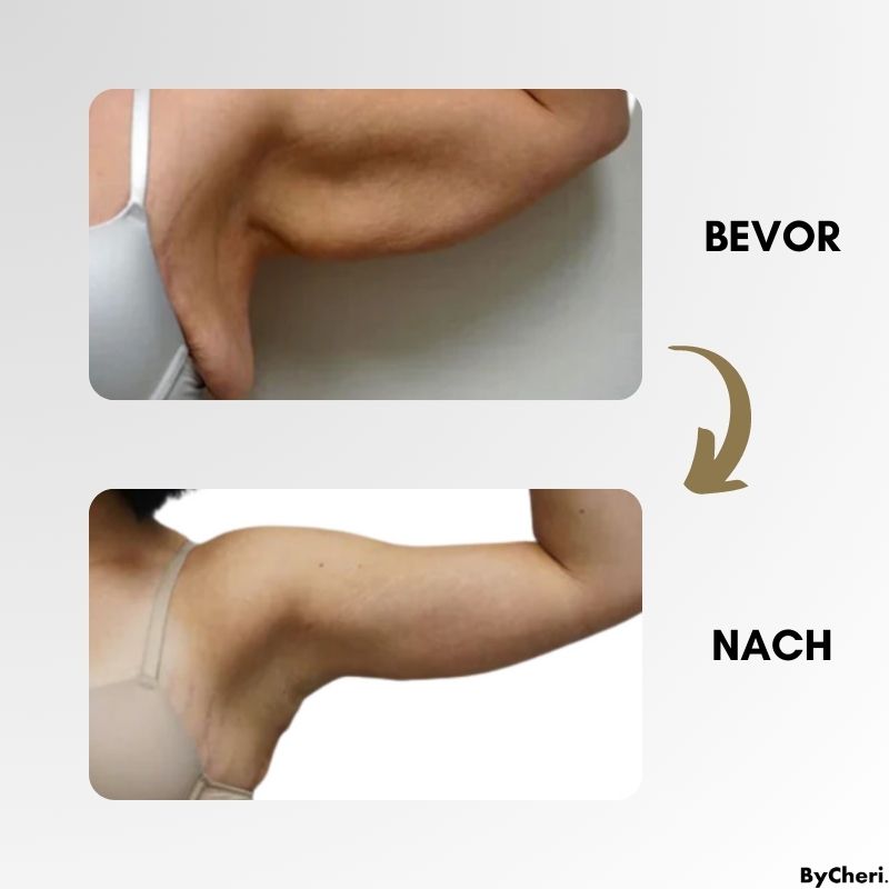 (50 % RABATT) LymphWave™- Hartnäckiges Fett mit Lymphstimulation bekämpfen