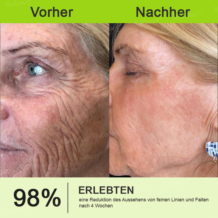 💫👨‍⚕️Jetzt jugendliche Haut zurückgewinnen 💫Rolimey® Botox & Vita-A Retinol Shot Falten-Lift Straffungscreme