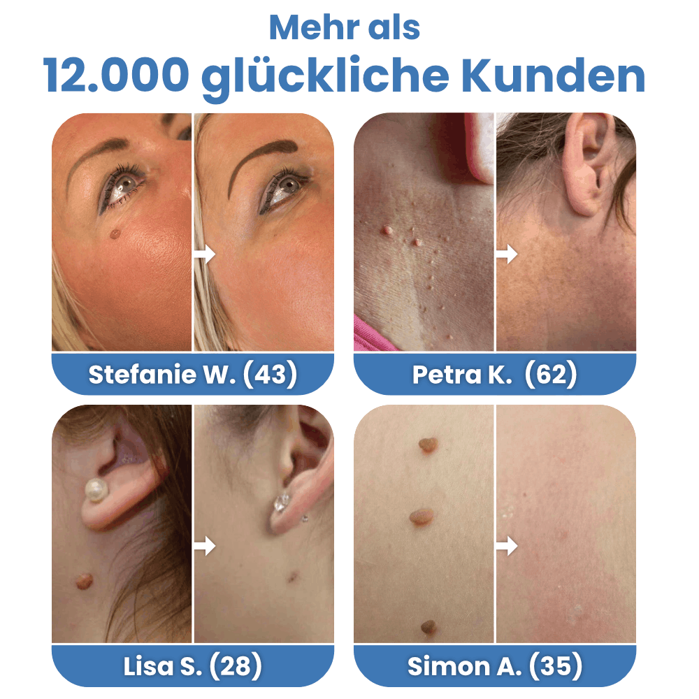 Schnell wirkende Warzenfrei-Lösung zur Entfernung von Stielwarzen – für jedermann