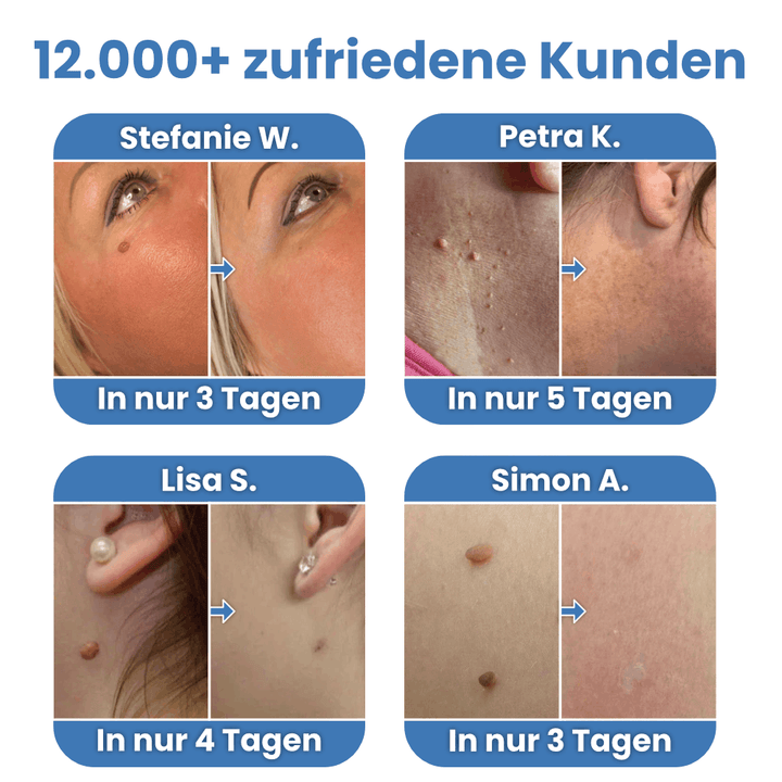 WarzenSanft™ Stielwarzen-Entferner