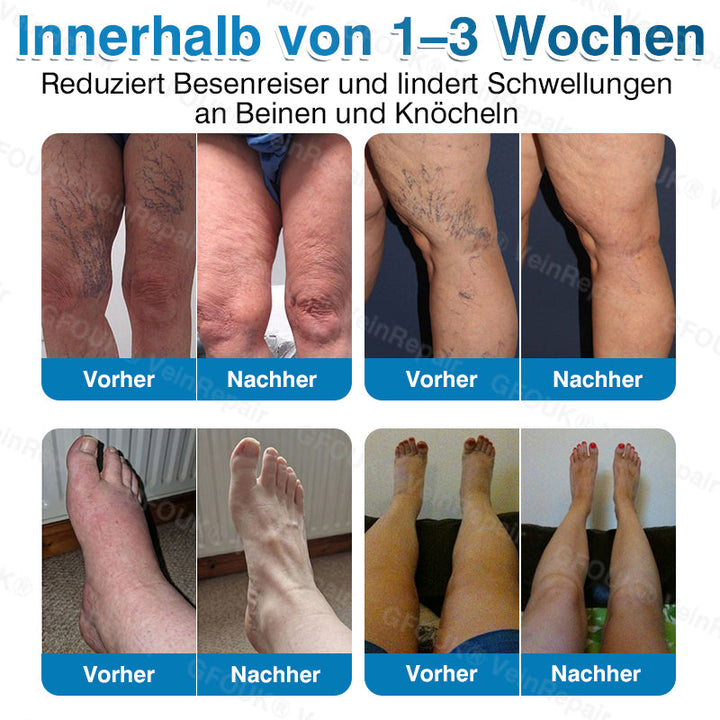 GFOUK® VeinRepair Mikronadel-Pflasterrolle⚡