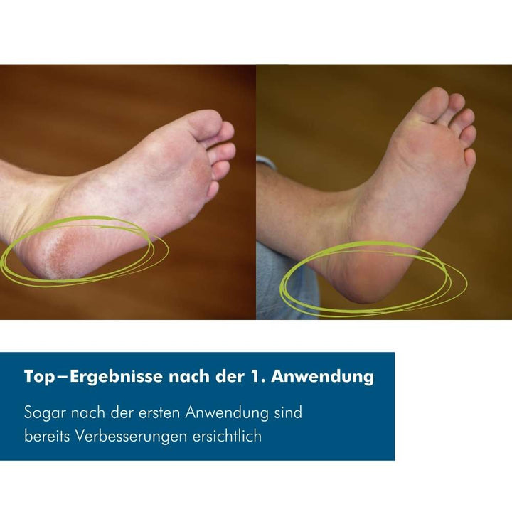 Novaro™ | Hand & Fußpflegebox | Hornhaut Entferner für glatte Füße in 20 Minuten