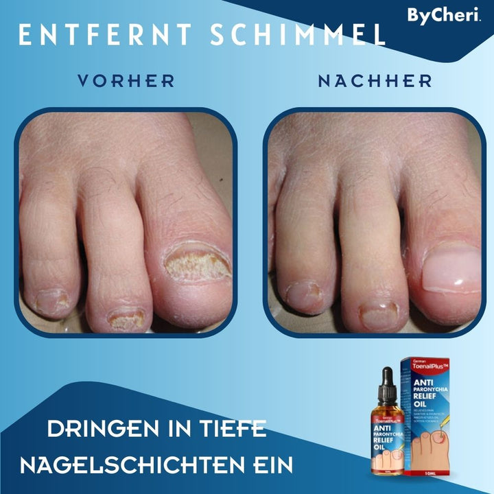 1+1 GRATIS TEMPORÄR | ToePerfect™ - Heilt Zehen- und Handnägel