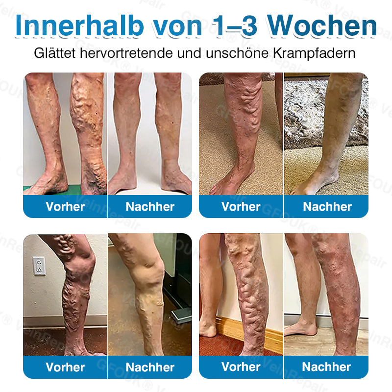 GFOUK® VeinRepair Mikronadel-Pflasterrolle⚡