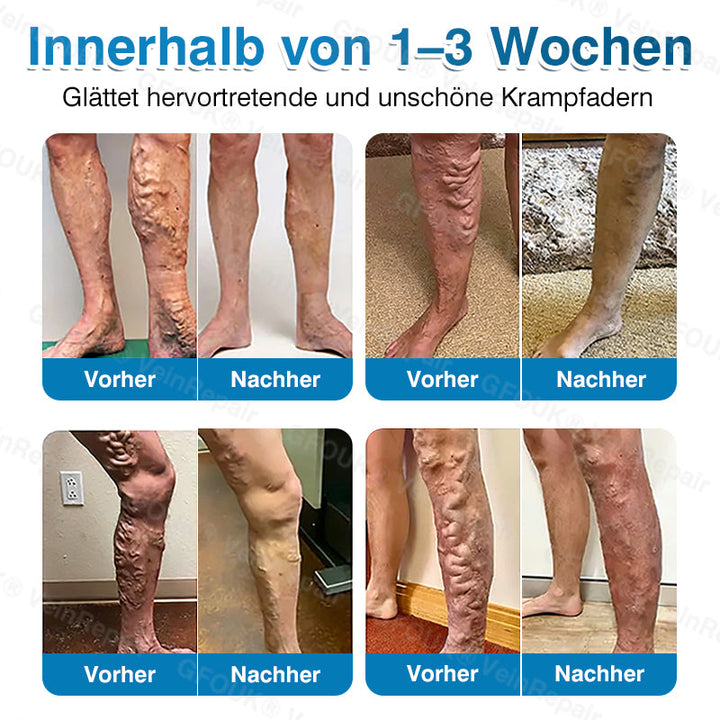 GFOUK® VeinRepair Mikronadel-Pflasterrolle⚡