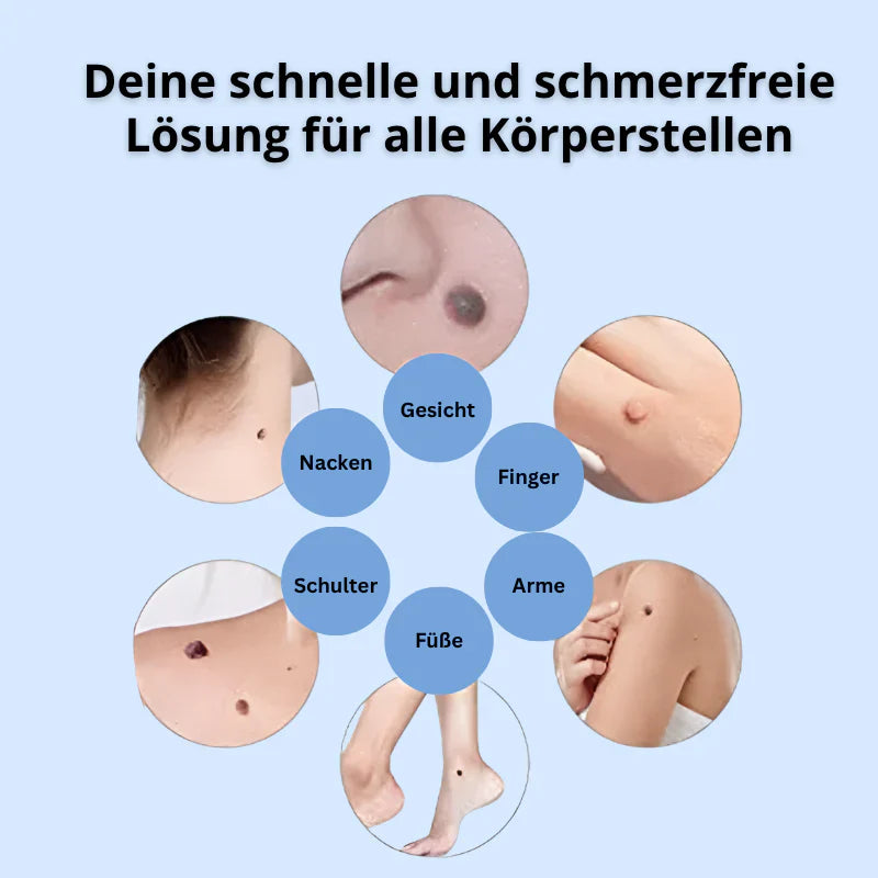 Dermalux® | Nie wieder Hautanhängsel