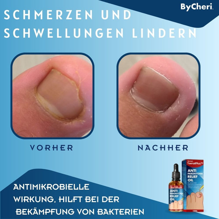 1+1 GRATIS TEMPORÄR | ToePerfect™ - Heilt Zehen- und Handnägel