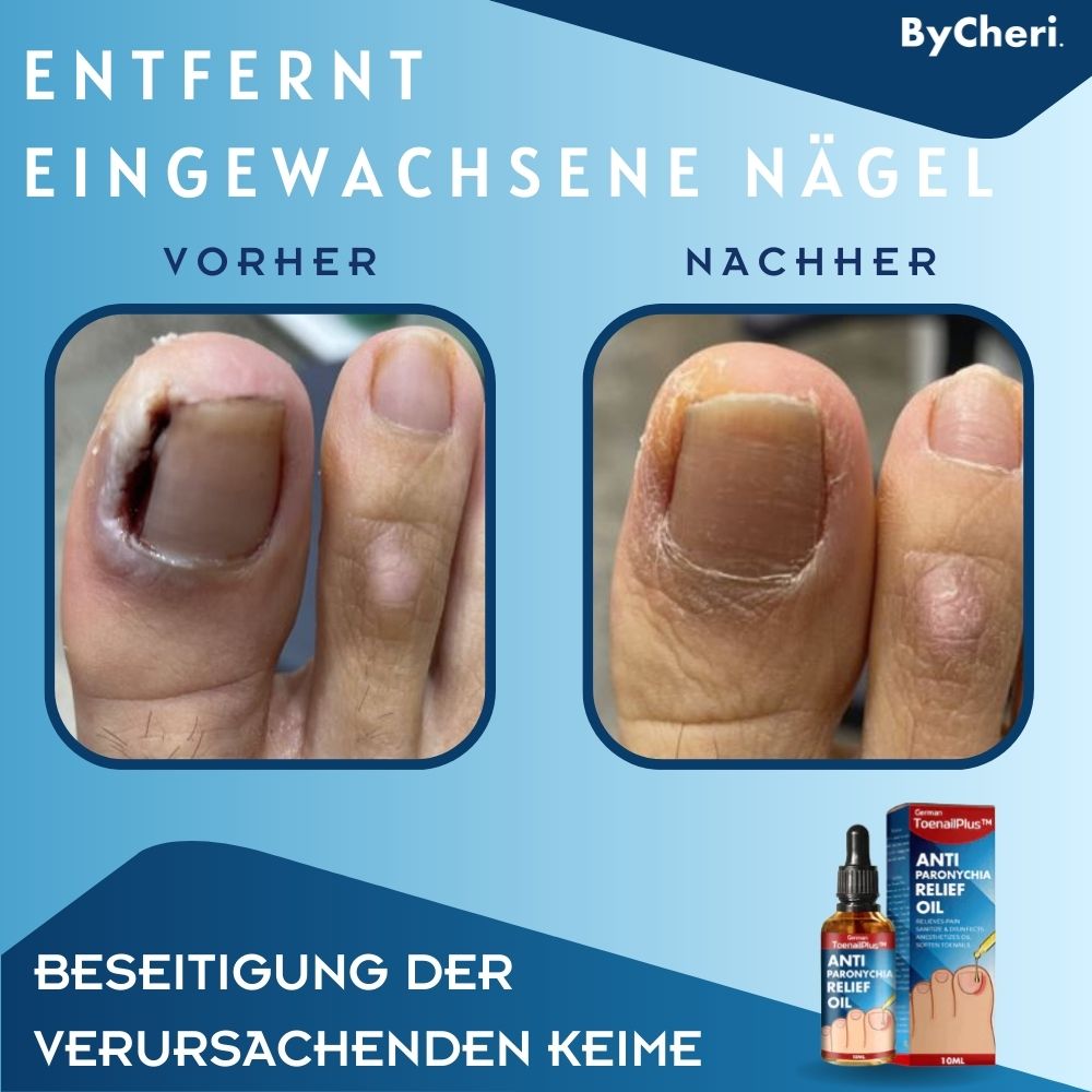 1+1 GRATIS TEMPORÄR | ToePerfect™ - Heilt Zehen- und Handnägel