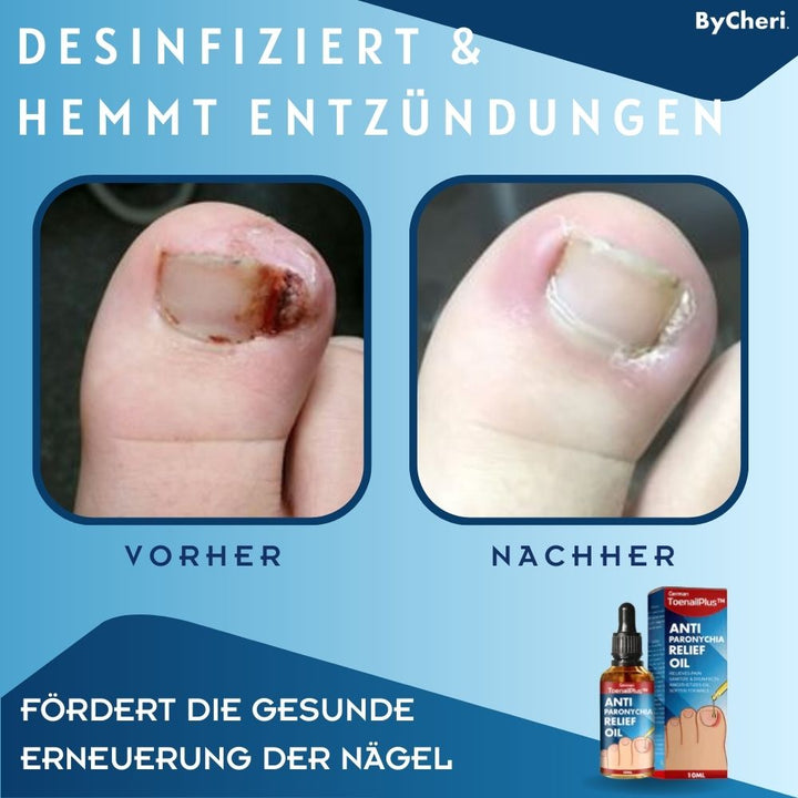1+1 GRATIS TEMPORÄR | ToePerfect™ - Heilt Zehen- und Handnägel