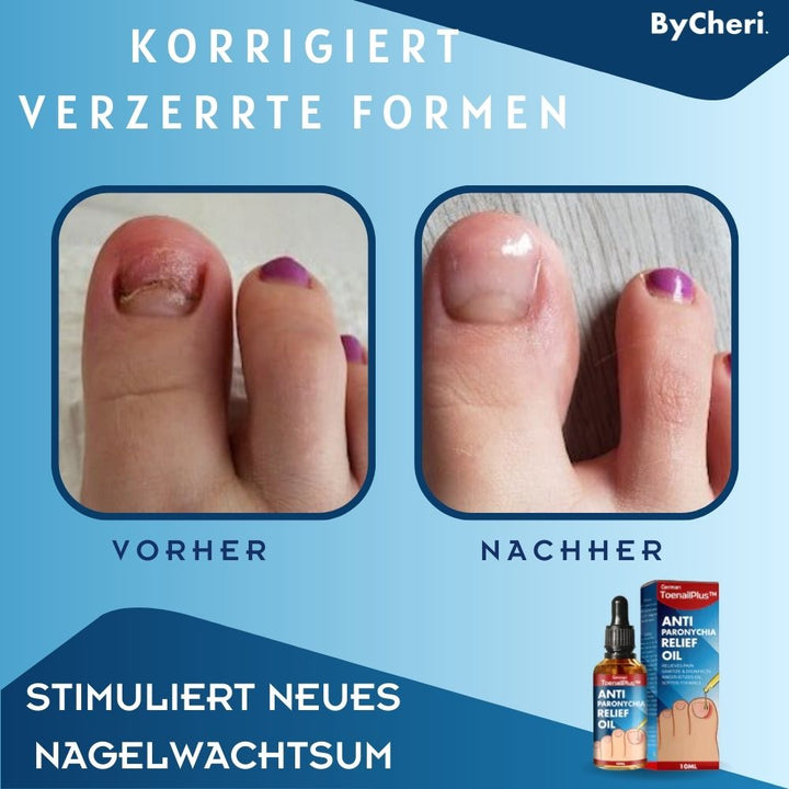 1+1 GRATIS TEMPORÄR | ToePerfect™ - Heilt Zehen- und Handnägel