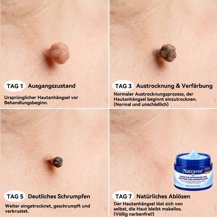 HautKlar™ Pflegecreme für Hautanhängsel & Hautflecken