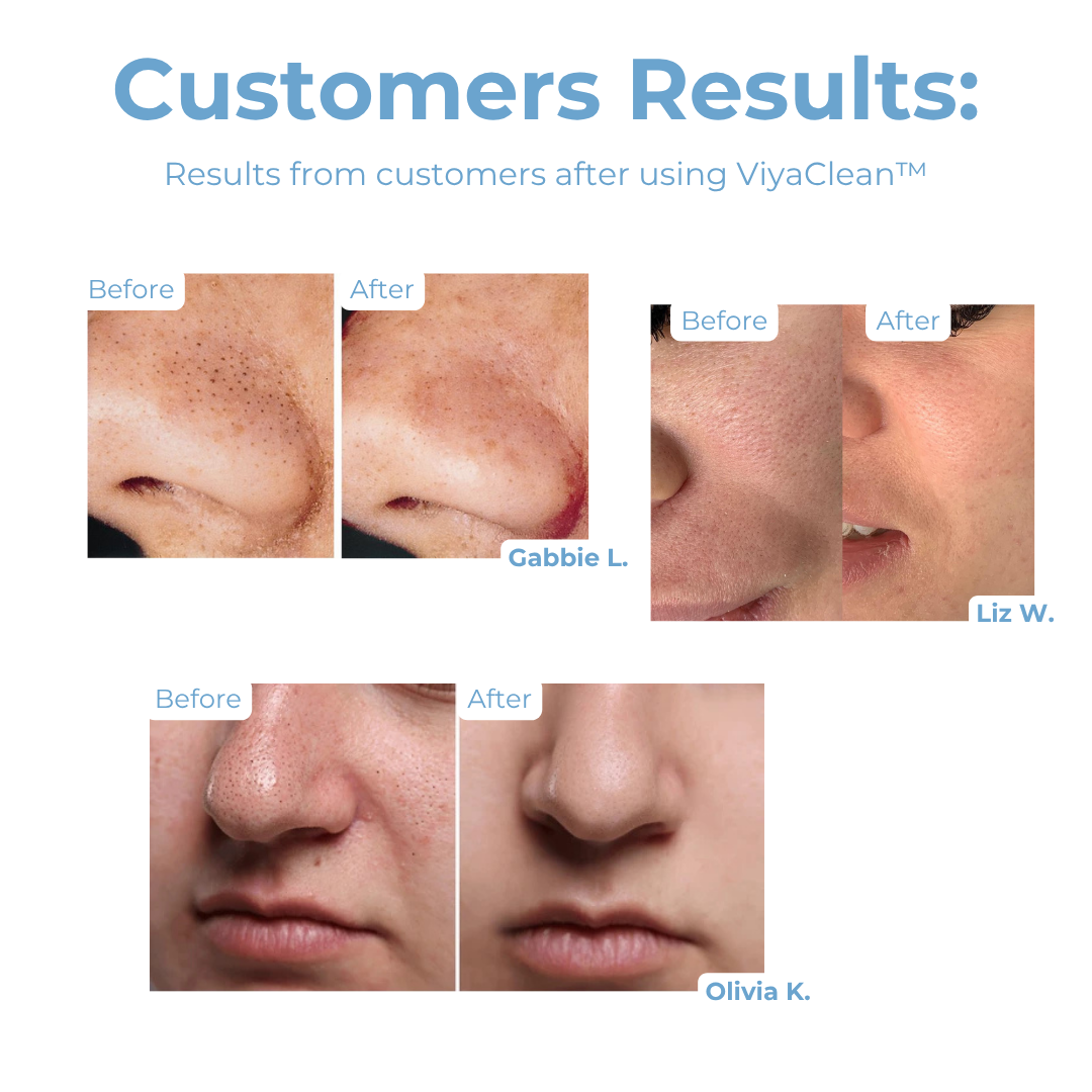 ViyaClean™ – Porenreinigungs-Serum, sanft, effektiv, gründlich & sichtbar reinigend [5 + 5 Gratis]