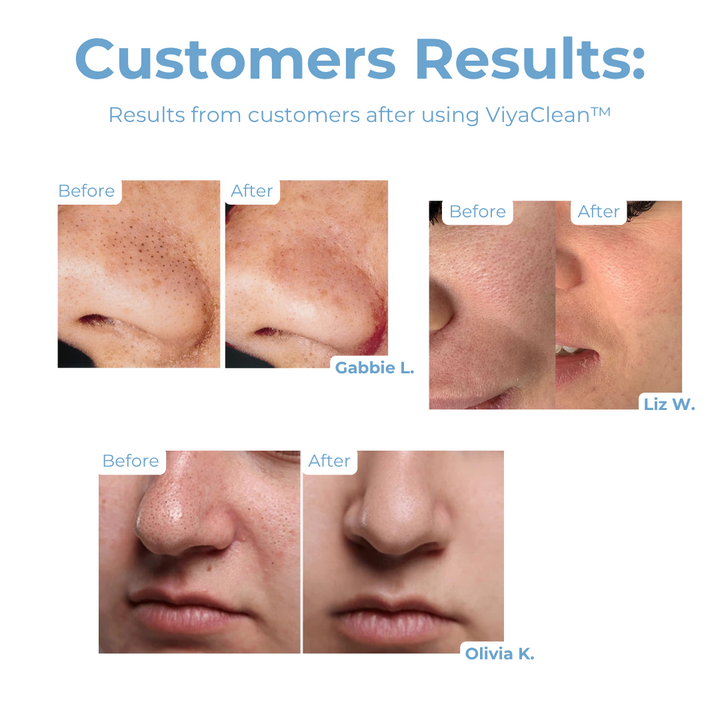 ViyaClean™ – Porenreinigungs-Serum, sanft, effektiv, gründlich & sichtbar reinigend [5 + 5 Gratis]