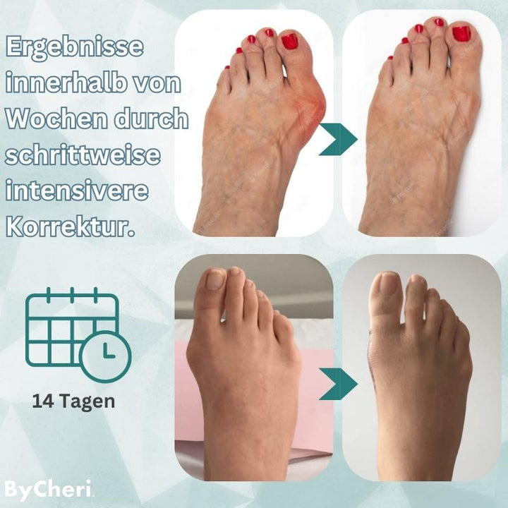 1+1 GRATIS TEMPORÄR | OrthoAlign™ – Großzehenkorrektor