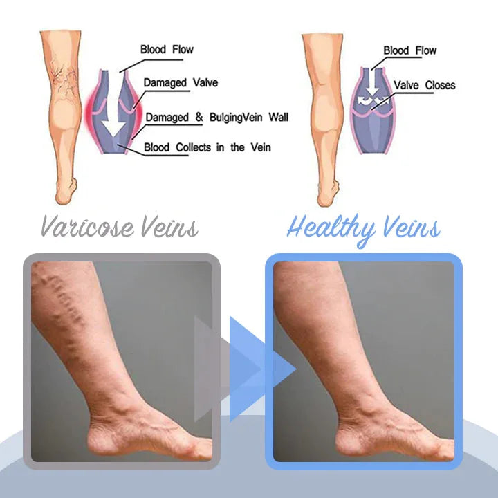 VariCose™ – Effektives Krampfader-Spray für schnelle Linderung und gesunde Beine [1 + 1 Gratis]