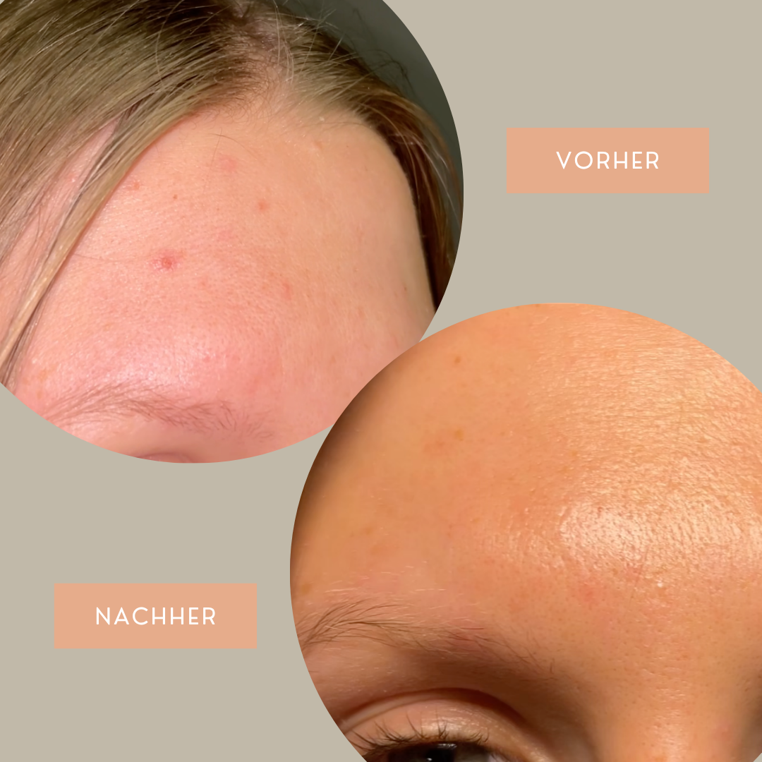 PuraPatch™ – Sanfter Pickel-Roller für ein reineres Hautbild