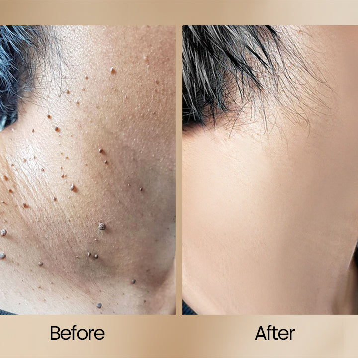 ClearSkin™ – Bienenvenen-Warzenentfernungsspray, effektiv, schnell und schonend [50% Rabatt]