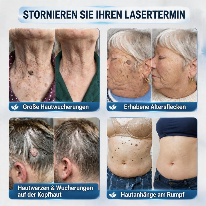 HautKlar™ Pflegecreme für Hautanhängsel & Hautflecken