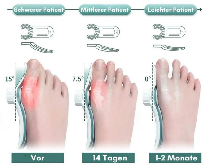 1+1 GRATIS TEMPORÄR | OrthoAlign™ – Großzehenkorrektor