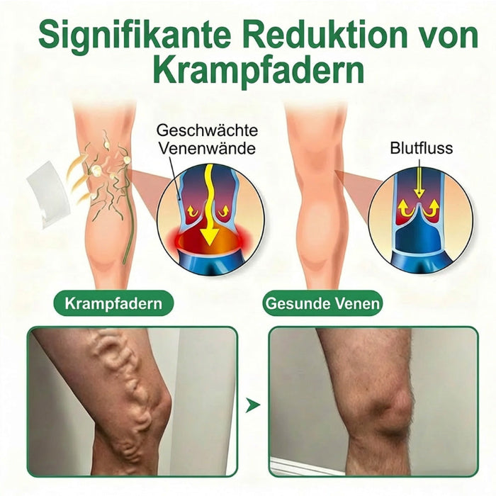 VenenSanft™ Mikronadel-Pflege für die Beine