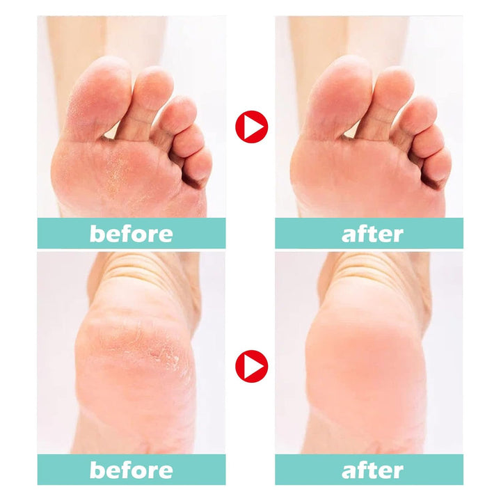 FootCream™ – Heilende und schützende Pflege für rissige Haut, für langanhaltenden Komfort [1 + 1 Gratis]