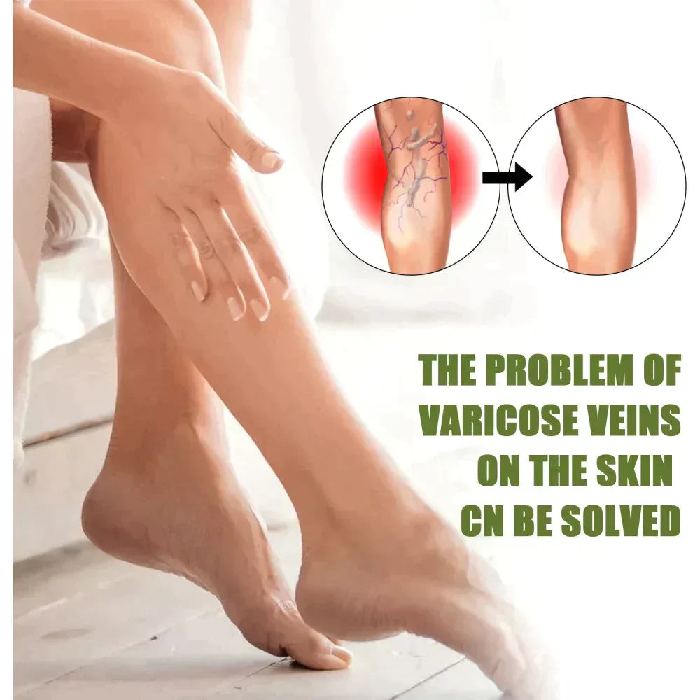VariCose™ – Effektives Krampfader-Spray für schnelle Linderung und gesunde Beine [1 + 1 Gratis]