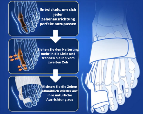 Flex-Ballenzehkorrektor - Rette deinen Zeh bevor es zu spät ist!