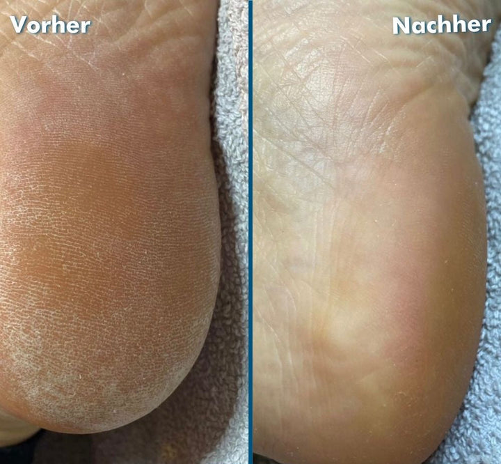 Novaro™ | Hand & Fußpflegebox | Hornhaut Entferner für glatte Füße in 20 Minuten