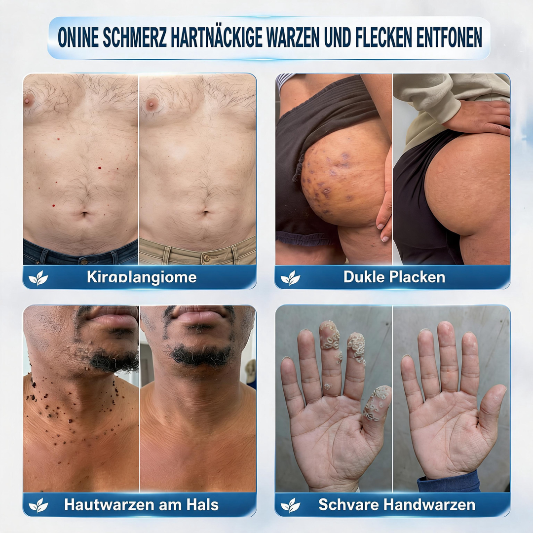 HautKlar™ Pflegecreme für Hautanhängsel & Hautflecken