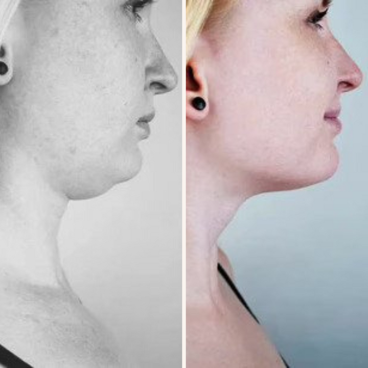 50% RABATT | TheraSpa®️ | EMS Vface Lymphatisches Massagegerät