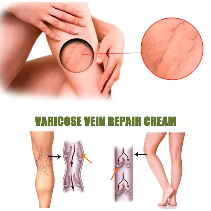 VariCose™ – Effektives Krampfader-Spray für schnelle Linderung und gesunde Beine [1 + 1 Gratis]