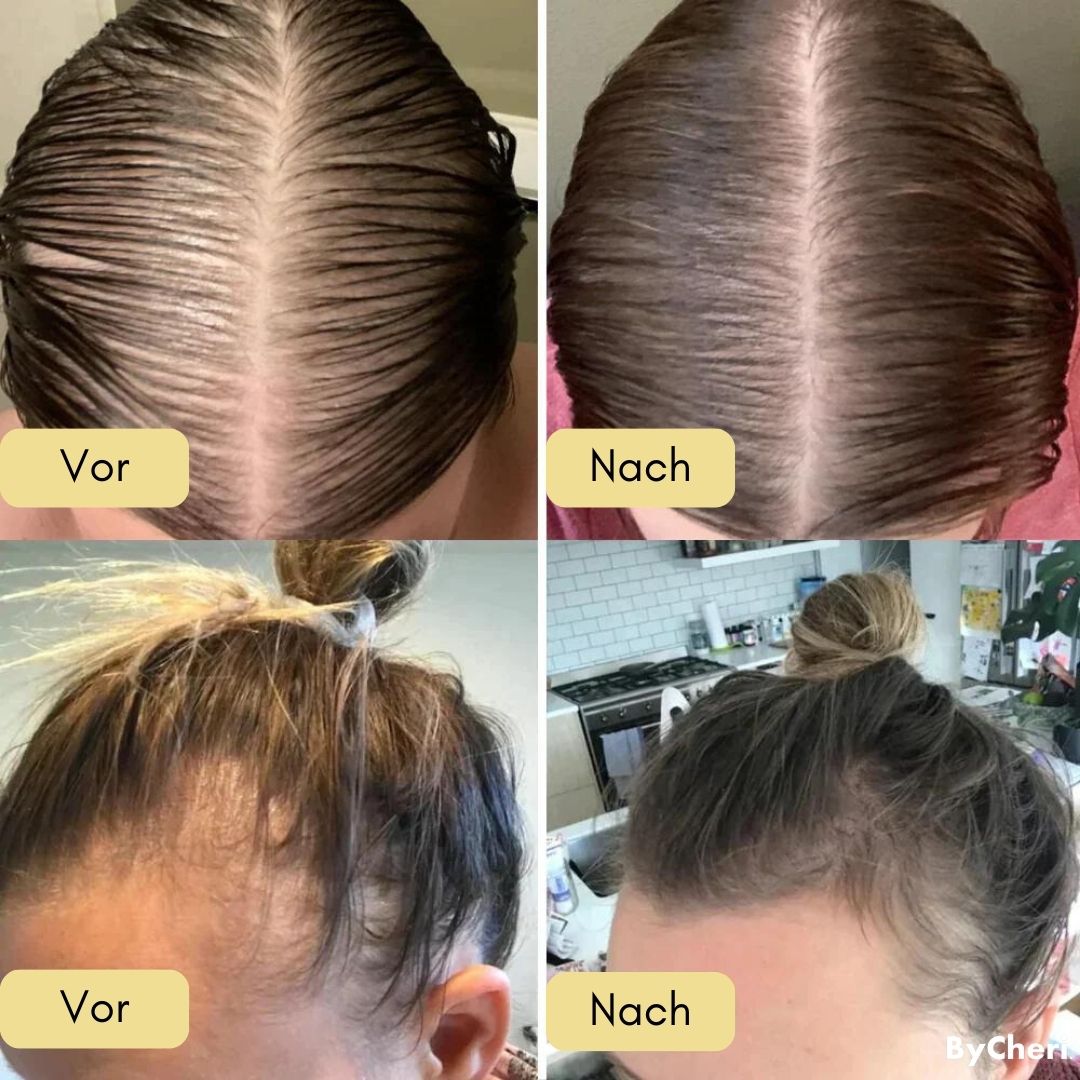 VitalGrow™ |  Ihre natürliche Ölbehandlung für Haarwachstum | 50% RABATT