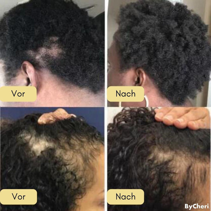 VitalGrow™ |  Ihre natürliche Ölbehandlung für Haarwachstum | 50% RABATT