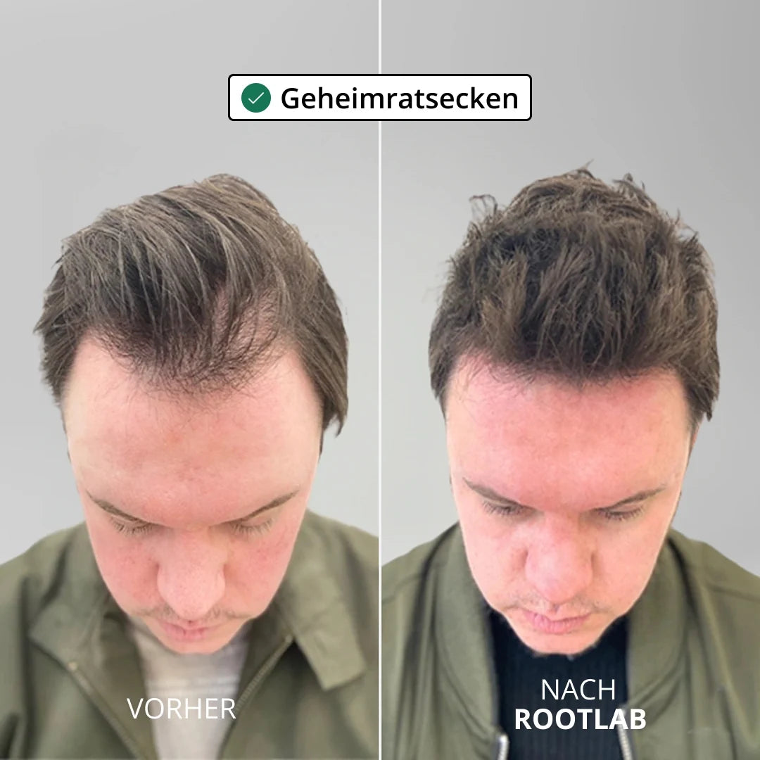 HairViva™ Haarwuchs-System für kräftigeres und dichteres Haar
