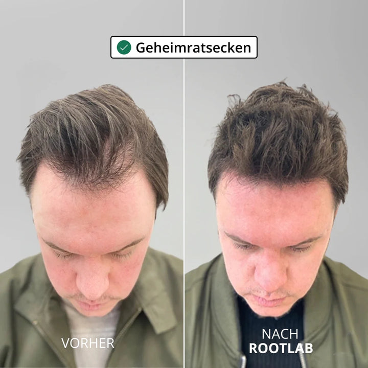 HairViva™ Haarwuchs-System für kräftigeres und dichteres Haar