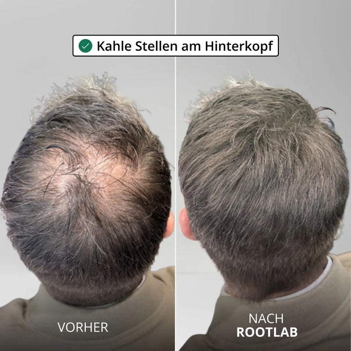 HairViva™ Haarwuchs-System für kräftigeres und dichteres Haar