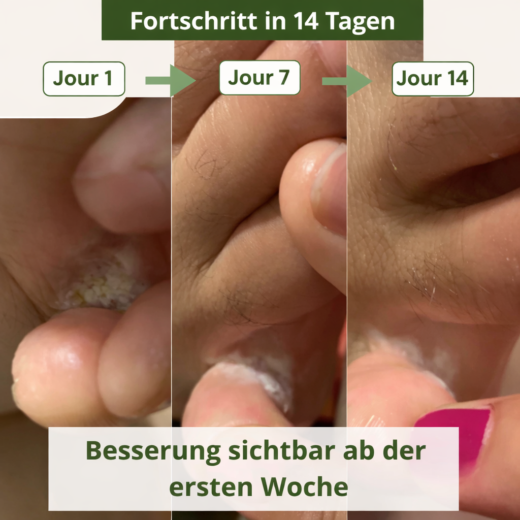 PilzKlar™ Anti-Pilz-Seife