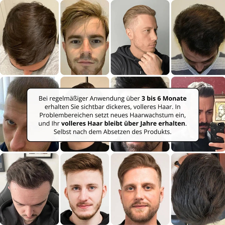 HairViva™ Haarwuchs-System für kräftigeres und dichteres Haar