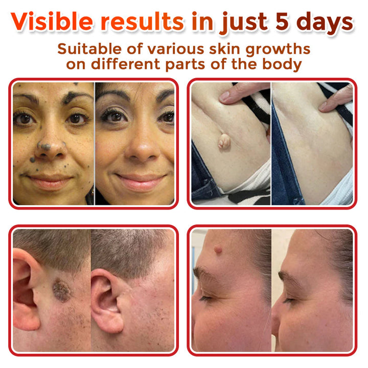 SkinTag™ – Lässt Hautanhängsel mühelos verschwinden für glatte, makellose Haut [1 + 1 Gratis]