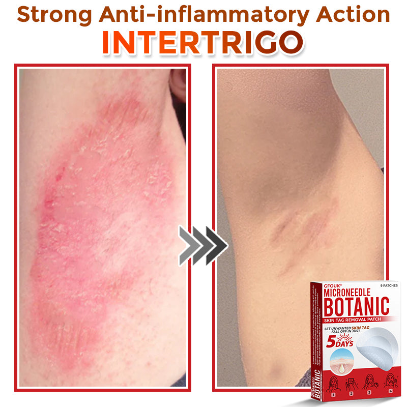 SkinTag™ – Lässt Hautanhängsel mühelos verschwinden für glatte, makellose Haut [50% Rabatt]