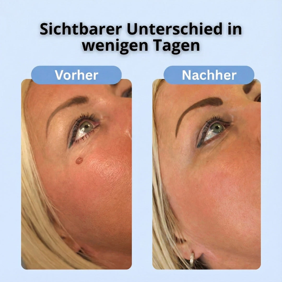 Dermalux® | Nie wieder Hautanhängsel