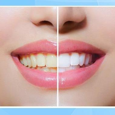 WhiteEssence™ – Zahnaufhellungsstift für Strahlend Weiße & Gesunde Zähne [1 + 1 Gratis]