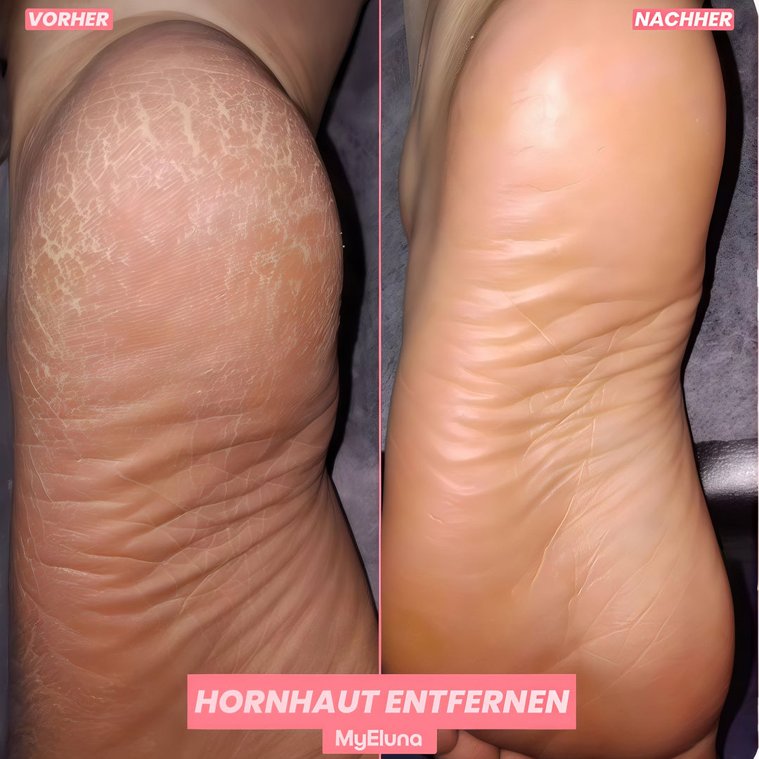 FußGlatt™ Elektrischer Hornhautentferner