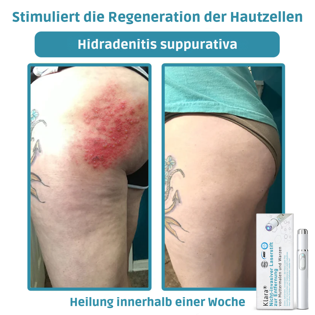 Klara™ – Enthülle jederzeit makellose, strahlende Haut und Selbstvertrauen [50% Rabatt]