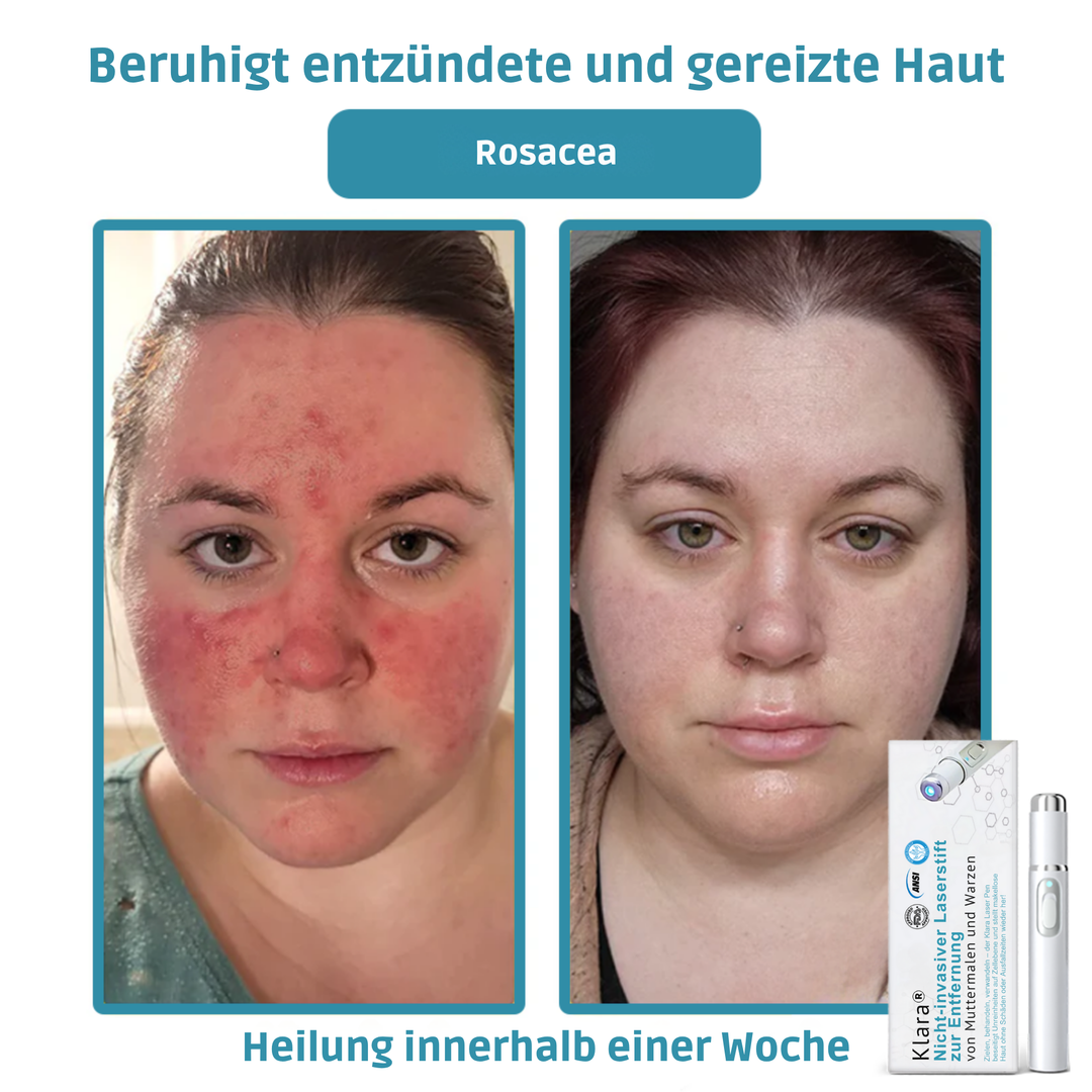 Klara™ – Enthülle jederzeit makellose, strahlende Haut und Selbstvertrauen [50% Rabatt]