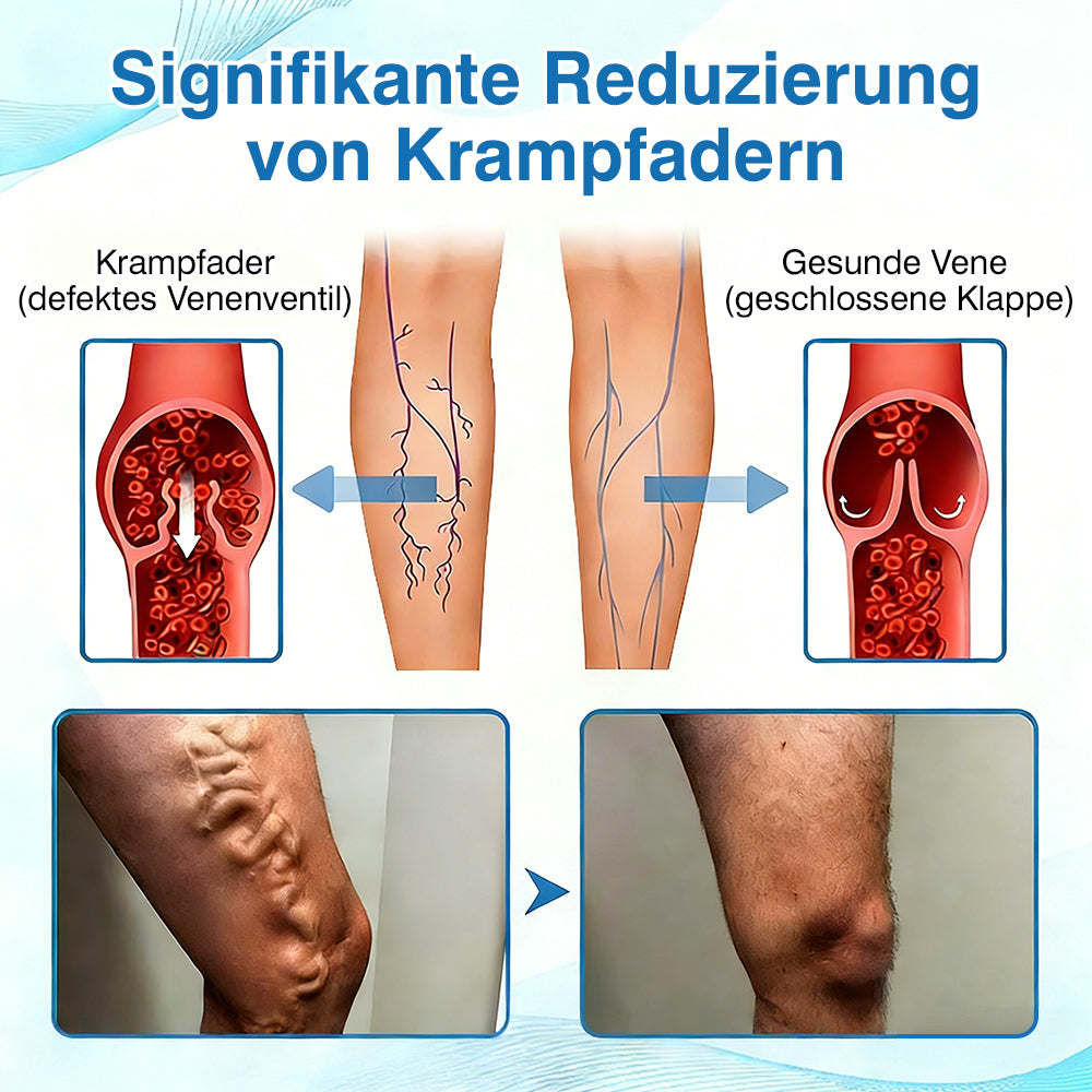 🇩🇪🏃‍🌿GFOUK® VascuCare Vein Healing Spray(Entwickelt für Krampfadern, Besenreiser, tiefe Venenthrombose (TVT), chronische venöse Insuffizienz, venöse Geschwüre, Thrombophlebitis und andere venöse Beschwerden)