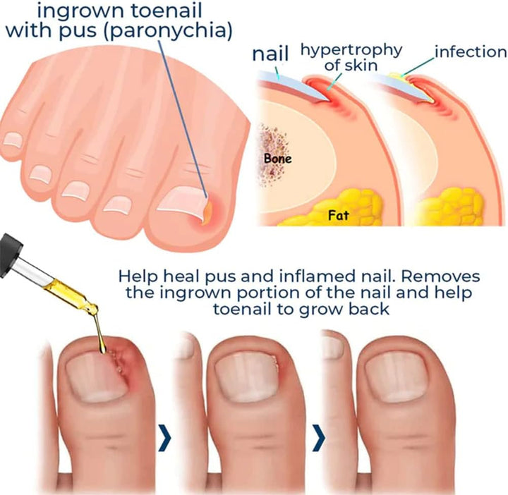 HealNail™ – Brittle Nail Repair für sichtbare Ergebnisse & einfache Anwendung [1 + 1 Gratis]